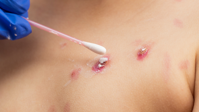 bai-viet/huong-dan-cach-ve-sinh-ngoai-da-dung-cach-cho-tre-nho-bi-thuy-dau.html