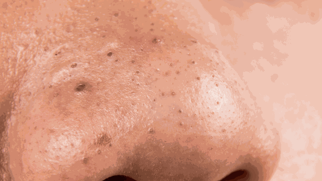 bai-viet/huong-dan-nan-mun-dau-den-o-mui-dung-cach-tai-nha.html