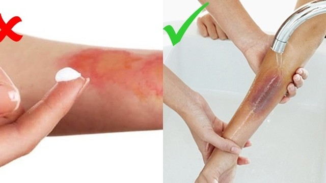 bai-viet/huong-dan-so-cuu-bong-dung-cach-theo-tung-muc-do-52202.html