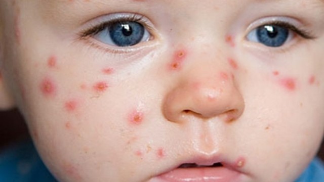 bai-viet/tim-hieu-thong-tin-be-bi-noi-man-do-co-mu-la-do-dau.html