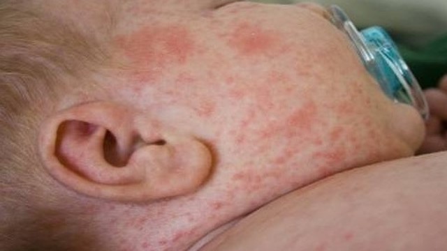 bai-viet/kem-chong-ham-bepanthen-balm-co-tri-duoc-rom-say-khong-58305.html