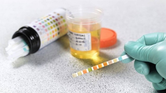 bai-viet/ketone-la-gi-y-nghia-cua-xet-nghiem-ketone-trong-nuoc-tieu-63321.html