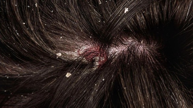 bai-viet/khac-phuc-nam-da-dau-voi-dau-goi-nazorel-shampoo-ciclopirox-olamine.html