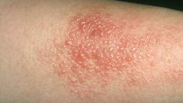 bai-viet/khi-bi-gioi-leo-boi-thuoc-gi-de-dieu-tri-hieu-qua.html