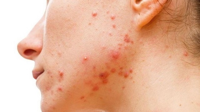 bai-viet/khi-dung-bha-bi-day-mun-thi-co-nen-nan-khong.html