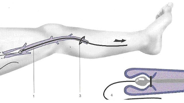 bai-viet/khi-nao-can-dieu-tri-suy-gian-tinh-mach-cac-phuong-phap-dieu-tri-hien-nay.html