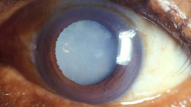 bai-viet/khi-nao-can-mo-duc-thuy-tinh-the-va-nhung-luu-y-quan-trong.html