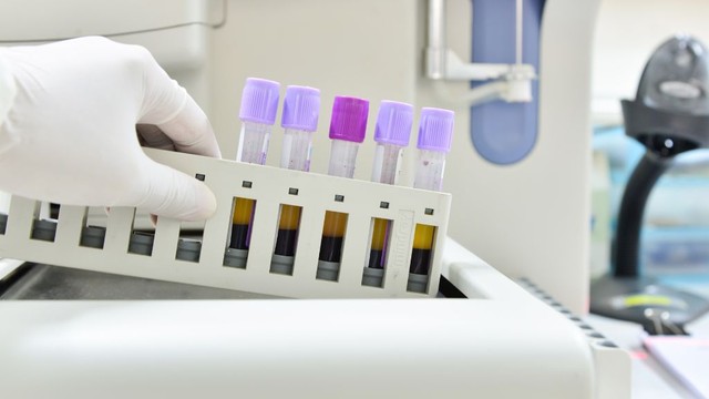 bai-viet/khi-nao-nen-xet-nghiem-tong-phan-tich-te-bao-mau-ngoai-vi.html