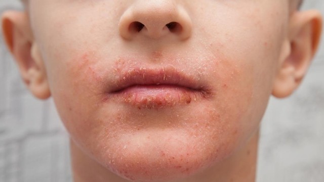 bai-viet/kho-da-quanh-mieng-nguyen-nhan-trieu-chung-cach-khac-phuc.html