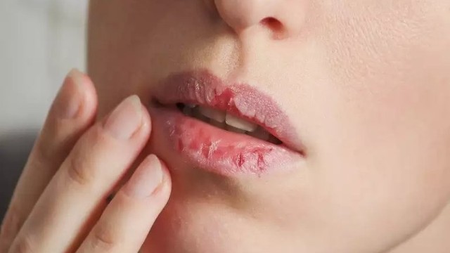 bai-viet/kho-moi-thieu-vitamin-gi-cach-chua-kho-moi-don-gian-62011.html