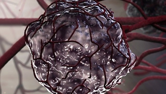 bai-viet/khoi-u-ac-tinh-co-phai-la-ung-thu-khong.html