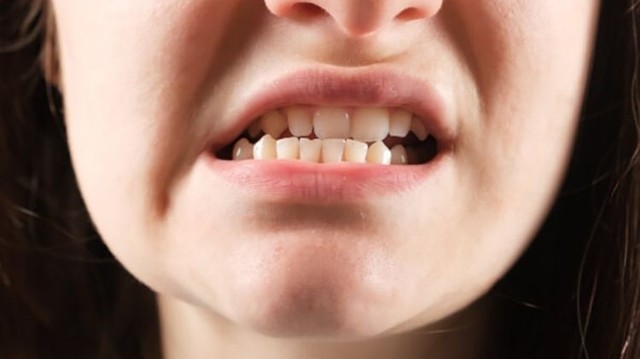 bai-viet/khop-can-nguoc-co-nen-tap-mewing-khong.html