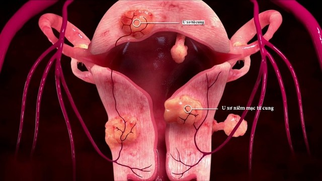 bai-viet/kich-thuoc-u-xo-tu-cung-bao-nhieu-la-to-hieu-ro-de-quan-ly-benh-hieu-qua.html