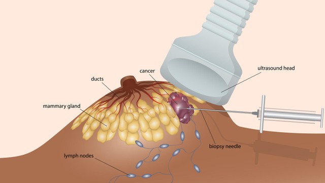 bai-viet/ky-thuat-hut-chan-khong-voi-may-vabb-trong-sinh-thiet-va-dieu-tri-u-tuyen-vu.html