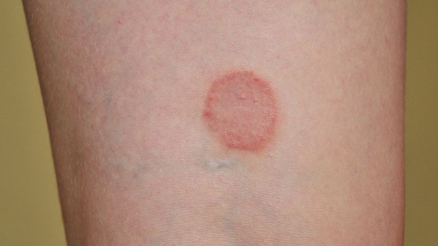 Lác đồng tiền là bệnh gì? Nguyên nhân, triệu chứng và cách điều trị hiệu quả