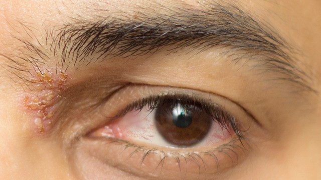 bai-viet/lam-gi-khi-bi-zona-o-mat-benh-zona-o-mat-co-lay-khong.html