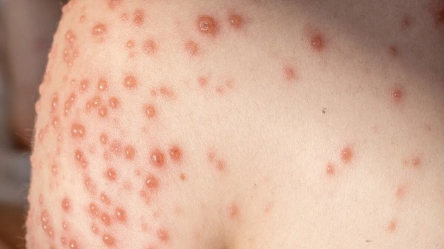 bai-viet/lam-gi-khi-thuy-dau-moc-qua-nhieu.html