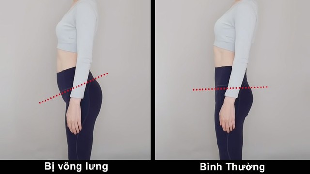 bai-viet/lam-sao-de-biet-minh-bi-vong-lung-luu-y-va-cach-dieu-tri-70072.html