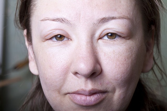 bai-viet/lam-sao-de-phan-biet-me-day-phu-quincke-54970.html