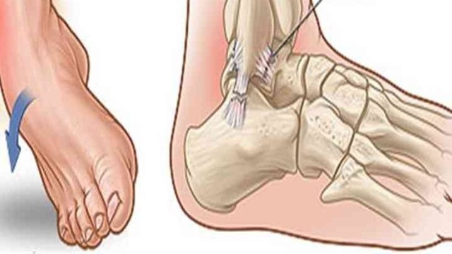 bai-viet/lat-so-mi-co-chan-la-gi-cach-dieu-tri-lat-so-mi-co-chan-an-toan-va-hieu-qua-54521.html