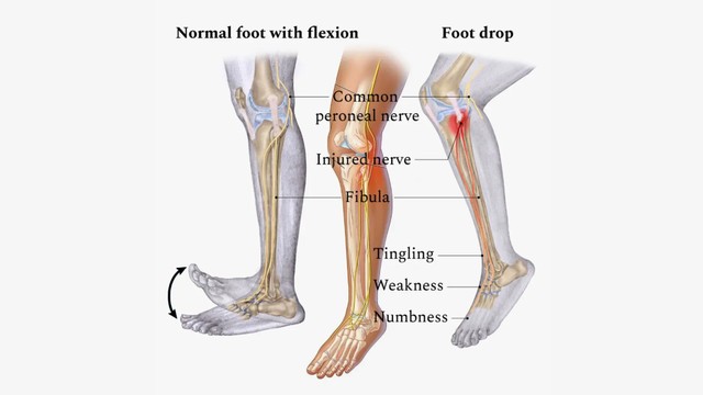 benh/liet-day-than-kinh-hong-khoeo-ngoai.html