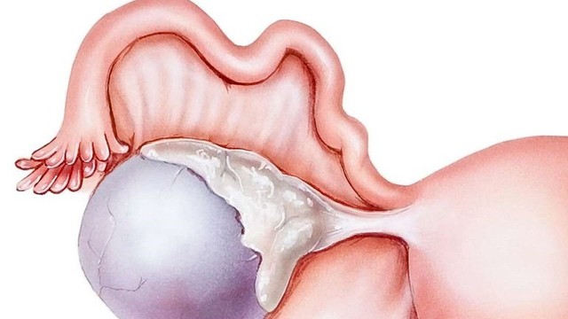 bai-viet/lieu-nang-naboth-co-tu-cung-co-phai-benh-ly-nguy-hiem-nguyen-nhan-va-cach-dieu-tri-71951.html