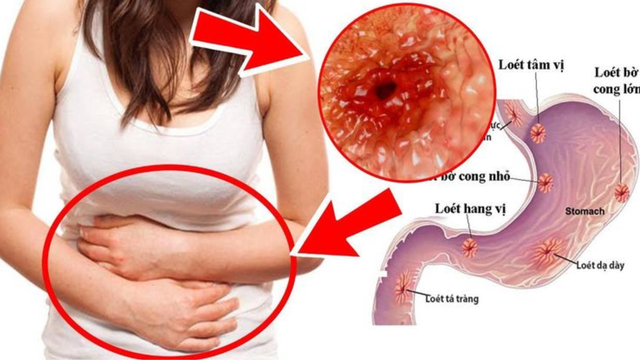 bai-viet/loet-hanh-ta-trang-forrest-3-dac-diem-dau-hieu-va-cach-xu-tri.html