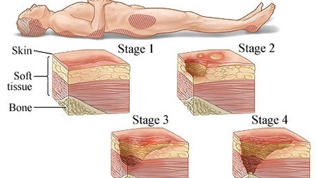 bai-viet/cac-loai-thuoc-chong-loet-ti-de-phu-hop-59466.html