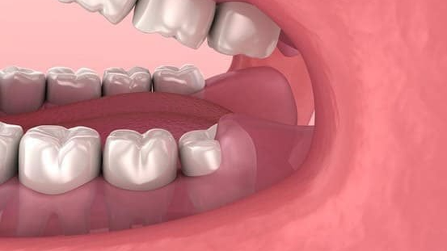 bai-viet/loi-thua-o-rang-ham-phai-lam-sao.html