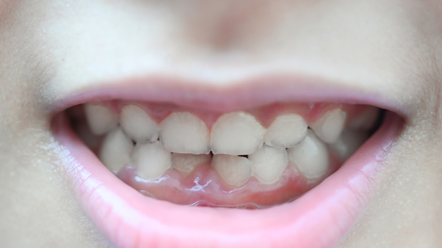 bai-viet/loi-trum-rang-cua-do-nguyen-nhan-nao-va-huong-khac-phuc-hieu-qua.html