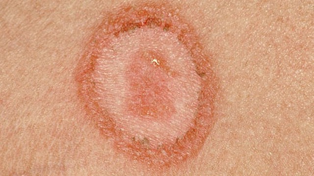 bai-viet/lupus-ban-do-dang-dia-co-ngua-khong-57278.html