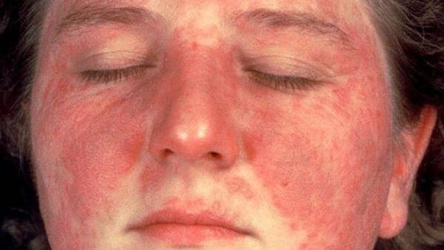 bai-viet/lupus-ban-do-he-thong-nguyen-nhan-va-cach-dieu-tri-57678.html