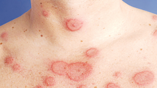 bai-viet/lupus-ban-do-o-co-co-nguy-hiem-khong-57141.html