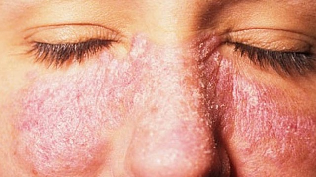 bai-viet/lupus-ban-do-tai-phat-co-the-dieu-tri-khoi-khong-56258.html