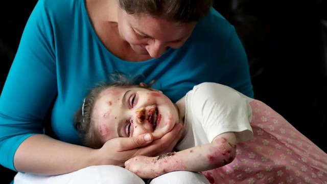 bai-viet/ly-thuong-bi-bong-nuoc-la-benh-gi-nguyen-nhan-trieu-chung-cach-dieu-tri.html