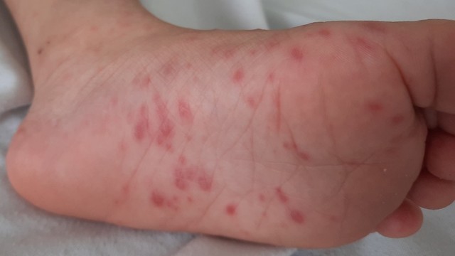 bai-viet/ma-icd-tay-chan-mieng-la-gi-va-nhung-thong-tin-can-biet-ve-ma-icd-tay-chan-mieng.html