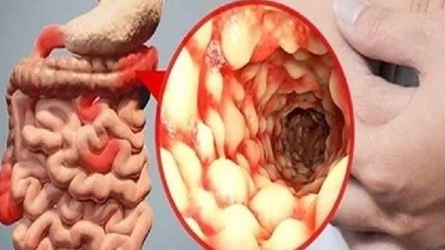 bai-viet/mac-benh-crohn-nen-an-gi-de-cai-thien-tinh-trang-benh1-56937.html