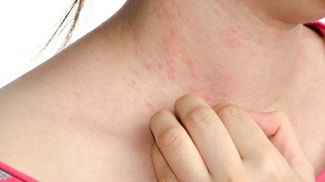 bai-viet/mac-benh-me-day-man-tinh-co-chua-duoc-khong-54733.html