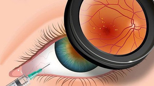 bai-viet/mac-benh-thoai-hoa-diem-vang-co-chua-duoc-khong-55547.html