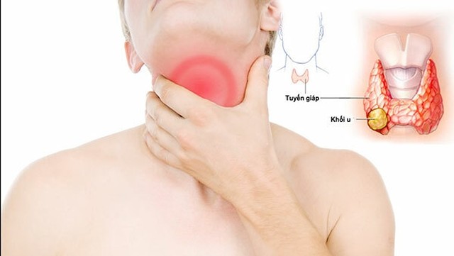 bai-viet/mac-benh-u-tuyen-giap-lanh-tinh-kieng-an-gi-nhung-luu-y-khi-bi-u-tuyen-giap-lanh-tinh.html