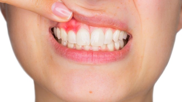 bai-viet/mac-benh-viem-chan-rang-uong-thuoc-gi-de-dieu-tri-benh-63243.html