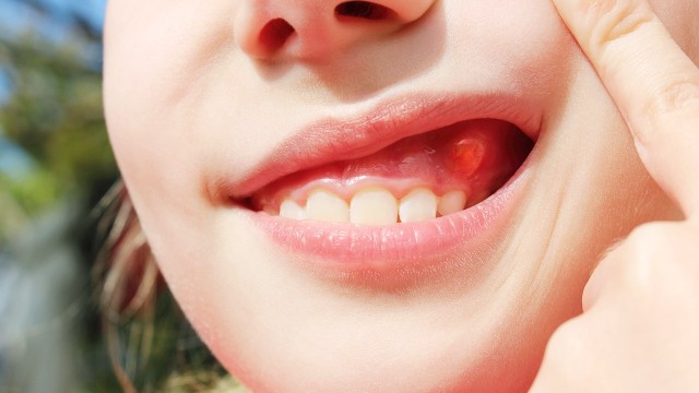 bai-viet/mach-ban-meo-chua-sung-mong-rang-hieu-qua.html