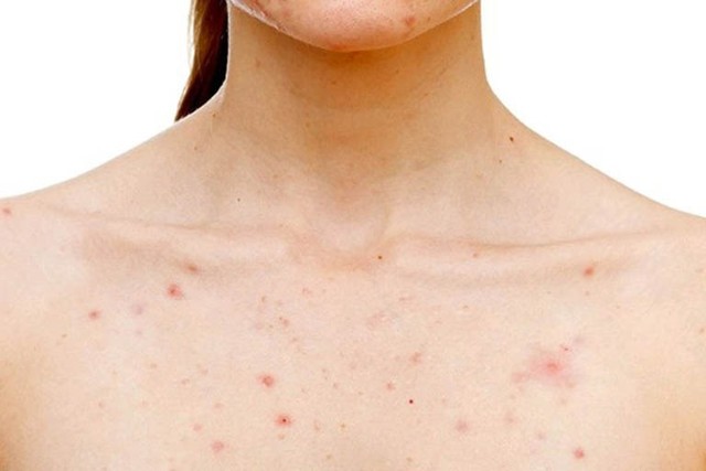 bai-viet/mach-ban-cach-chua-viem-nang-long-hieu-qua.html