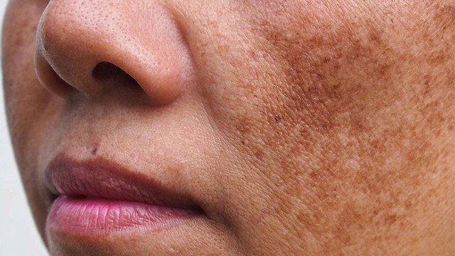 bai-viet/mach-ban-nhung-cach-tri-nam-hieu-qua-nhat-hien-nay.html