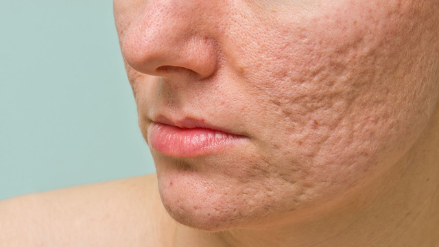 bai-viet/mach-ban-phuong-phap-tri-seo-lom-bang-trai-cay.html