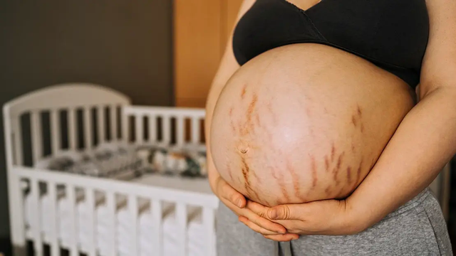 bai-viet/mach-cac-me-cach-tri-ran-da-bung-khi-mang-thai.html