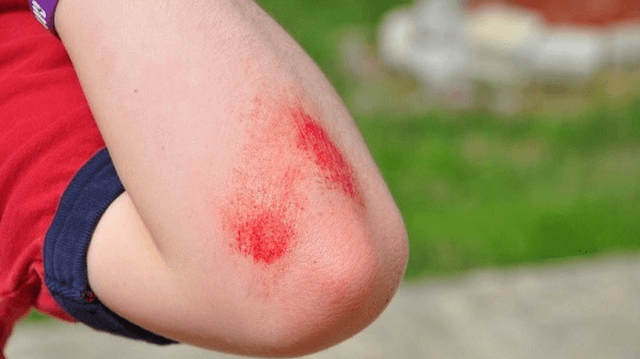 bai-viet/mach-me-cac-loai-thuoc-boi-tray-xuoc-da-cho-be-58143.html