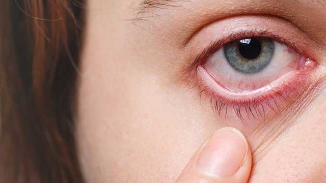 bai-viet/mat-bi-kho-rat-nguyen-nhan-cach-khac-phuc-va-bien-phap-phong-ngua.html