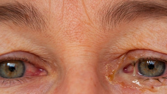 bai-viet/mat-co-mang-nhay-mau-trang-nguyen-nhan-va-cach-khac-phuc.html