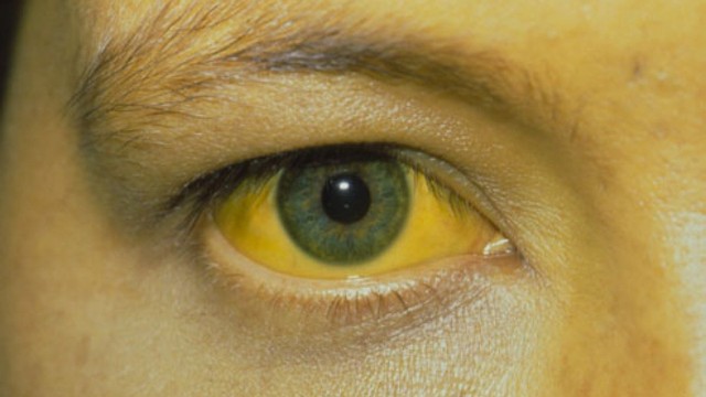 bai-viet/mat-vang-la-benh-gi-nguyen-nhan-dan-den-mat-vang.html